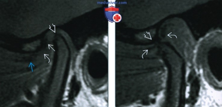 Смещение диска височно-нижнечелюстного сустава - лучевая диагностика