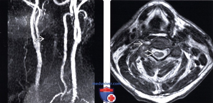 КТ, МРТ, ангиография сосудистых повреждений шейного отдела позвоночника