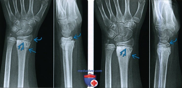 Признаки срастания перелома кости на рентгенограмме