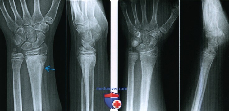 Признаки срастания перелома кости на рентгенограмме