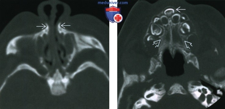 Одиночный срединный центральный резец верхней челюсти - лучевая диагностика