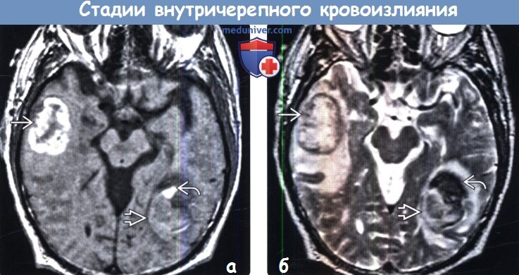 Стадии внутричерепного кровоизлияния на МРТ