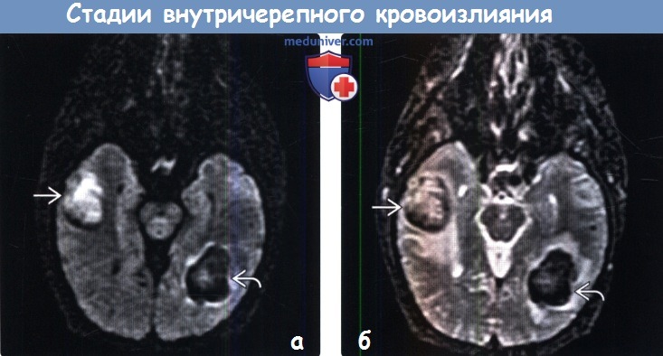 Стадии внутричерепного кровоизлияния на МРТ