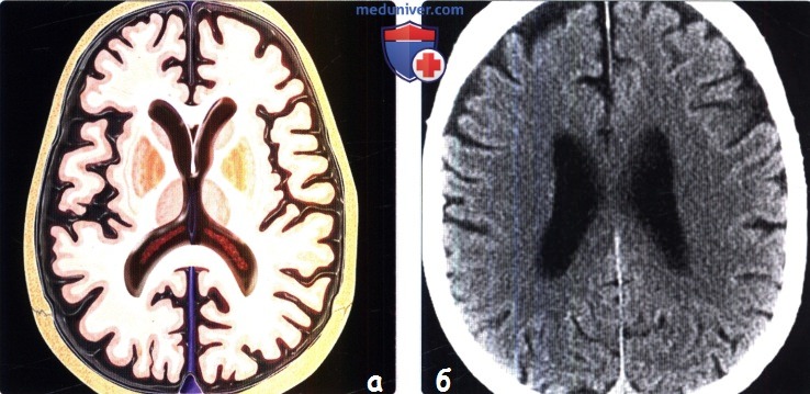 Нормальное старение головного мозга на МРТ