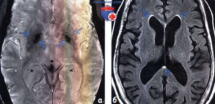Нормальное старение головного мозга на МРТ