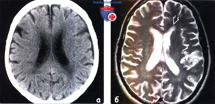 Нормальное старение головного мозга на КТ, МРТ