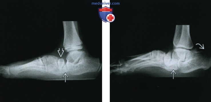 Врожденное вертикальное положение таранной кости («стопа-качалка») - лучевая диагностика