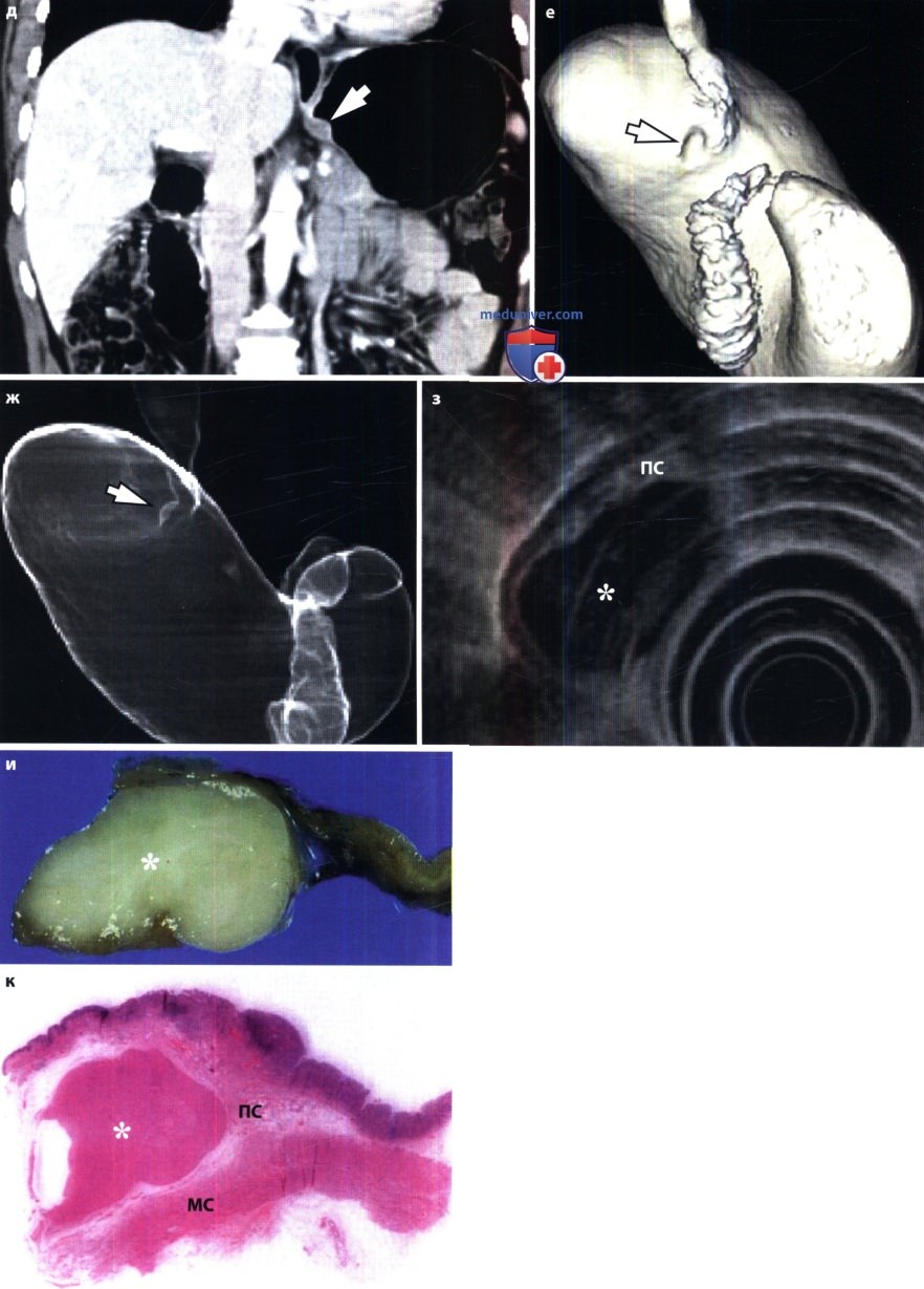 Рентгенограмма, КТ, УЗИ при лейомиоме желудка