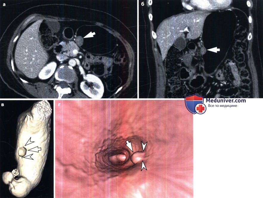 Рентгенограмма, КТ, УЗИ при гастроинтестинальной стромальной опухоли желудка