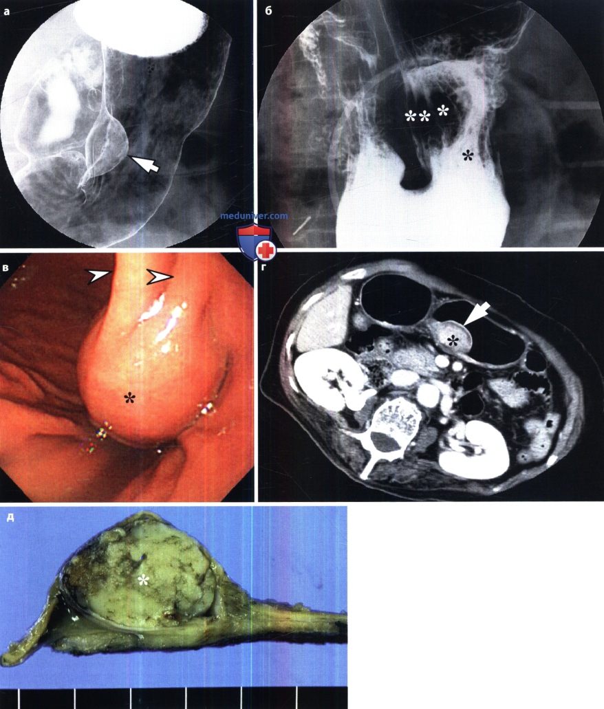 Рентгенограмма, КТ, УЗИ при гастроинтестинальной стромальной опухоли желудка