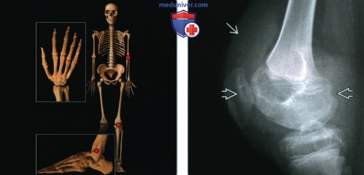 Суставы, кости при гемофилии - лучевая диагностика