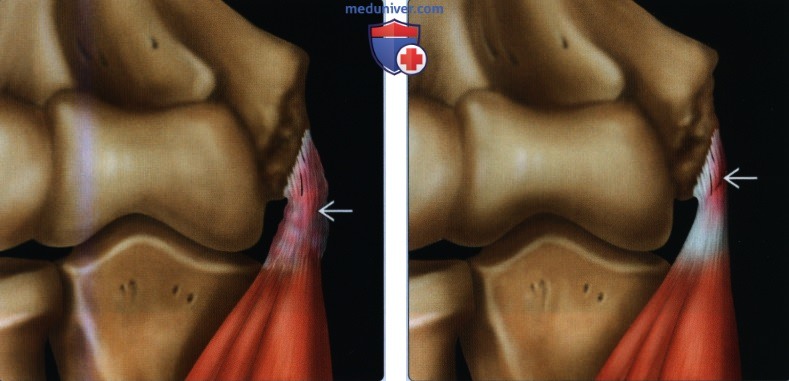 Признаки повреждения общего сухожилия сгибателя-пронатора на уровне локтевого сустава