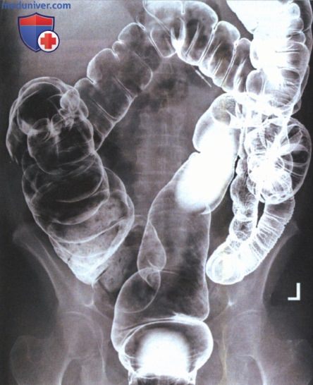 Техника рентгенографии тонкой кишки
