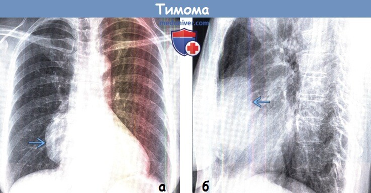 Тимома на рентгенограмме