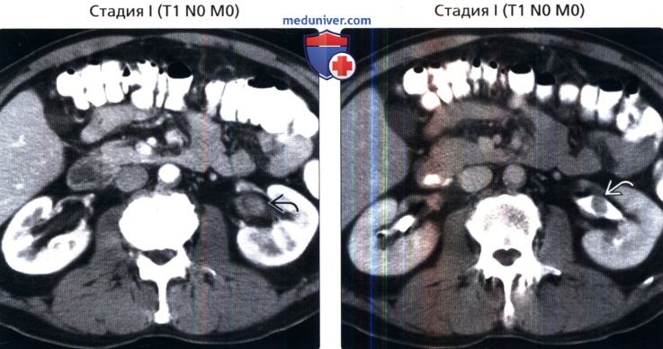 Рак 4 стадии с метастазами форум. Опухоль почечной лоханки кт. Папиллярная карцинома почки кт.