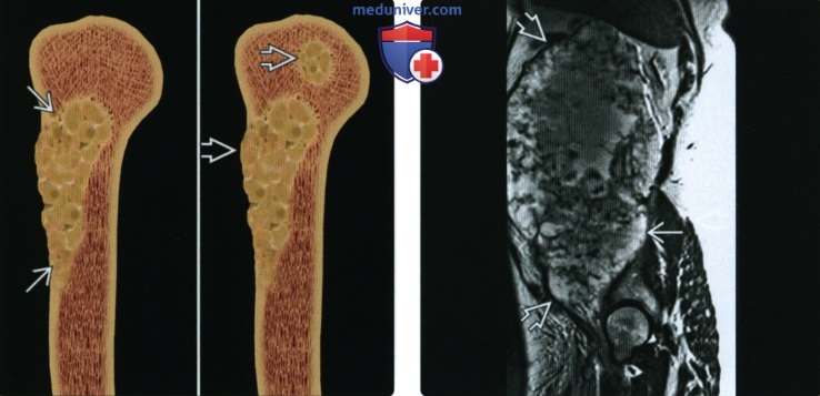 Лучевая диагностика опухоли кости: TNM классификация, стадии
