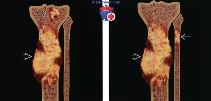 Лучевая диагностика опухоли кости: TNM классификация, стадии