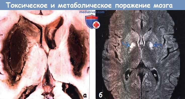 Токсическое и метаболическое поражение головного мозга на МРТ и гистологический макропрепарат