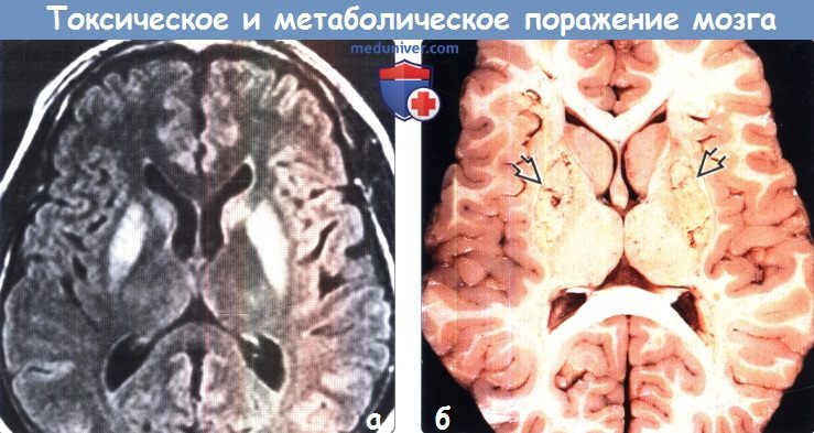Токсическое и метаболическое поражение головного мозга на МРТ и гистологический макропрепарат