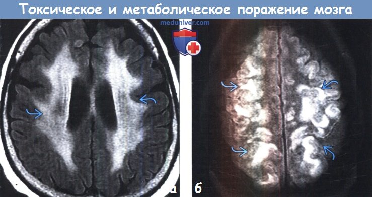 Токсическое и метаболическое поражение головного мозга на МРТ