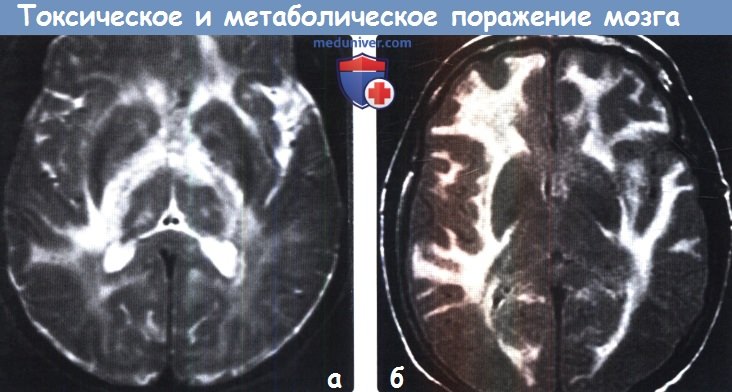 Токсическое и метаболическое поражение головного мозга на МРТ