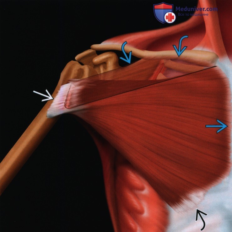Признаки травмы грудной мышцы