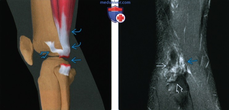 Признаки травмы латерального коллатерального связочного комплекса коленного сустава