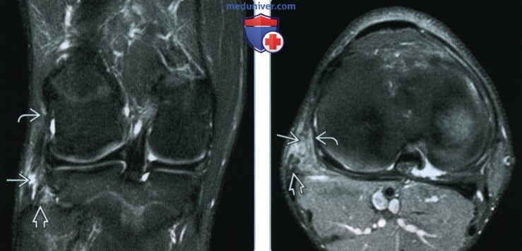 Признаки травмы латерального коллатерального связочного комплекса коленного сустава