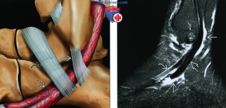 Признаки разрыва и тендинопатии сухожилий малоберцовых мышц