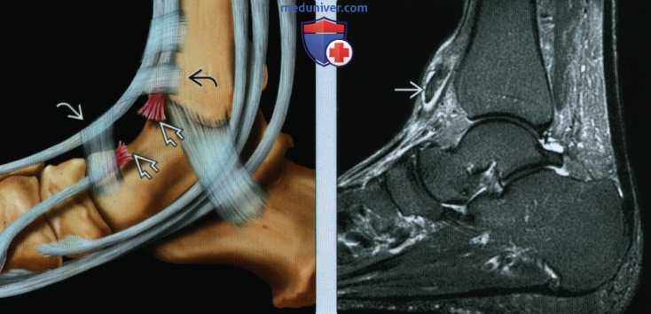 Признаки разрыва или тендинопатии сухожилий разгибателей стопы