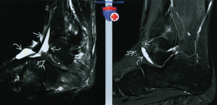 Признаки разрыва или тендинопатии сухожилий разгибателей стопы