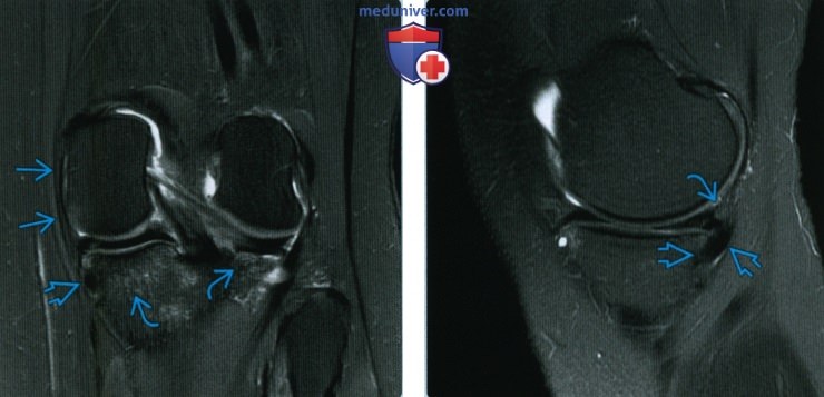 Признаки травмы заднемедиального угла коленного сустава