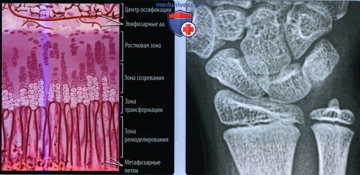 Признаки травматического остеолиза костей лучезапястного сустава у детей