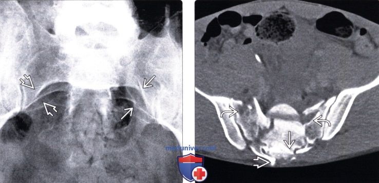 Рентгенограмма, КТ при травматическом переломе крестца