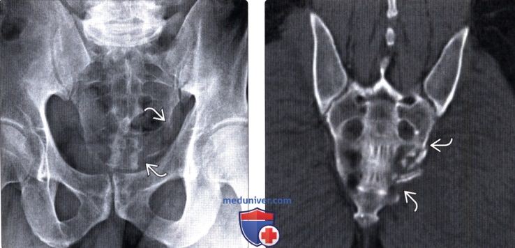 Перелом копчика рентгенологическая картина thumbnail
