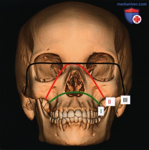 Введение в лучевую диагностику травм основания черепа и области лица: лучевая анатомия, методы исследования