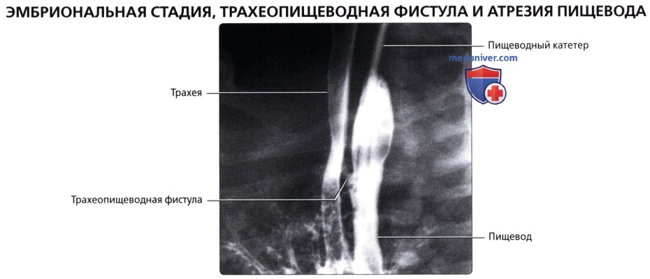 Рентгенограмма при трахеопищеводной фистуле, атрезии пищевода у новорожденного