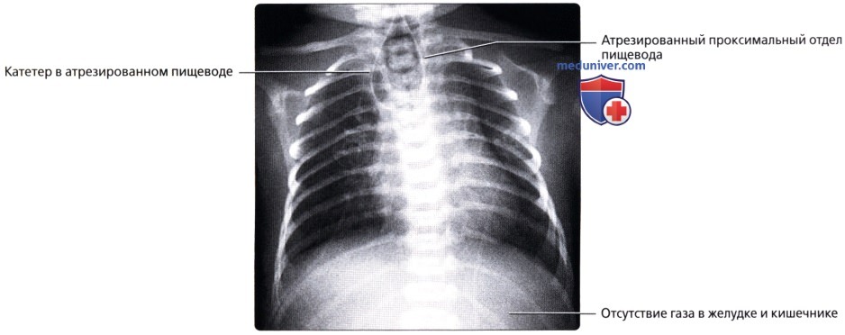Рентгенограмма при трахеопищеводной фистуле, атрезии пищевода у новорожденного