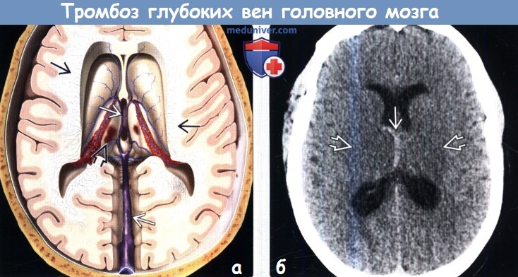 Тромбоз на кт. Тромбоз вен головного мозга кт. Тромбоз синусов головного мозга кт. Тромбоз глубоких вен головного мозга. Тромбоз головного мозга мрт.