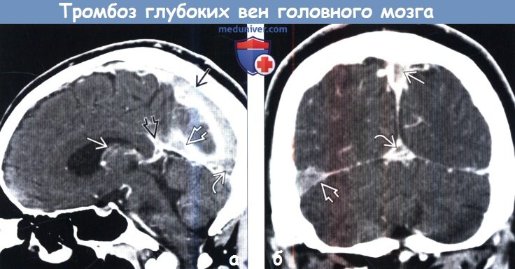 Тромбоз глубоких вен головного мозга на КТ, ангиограмме