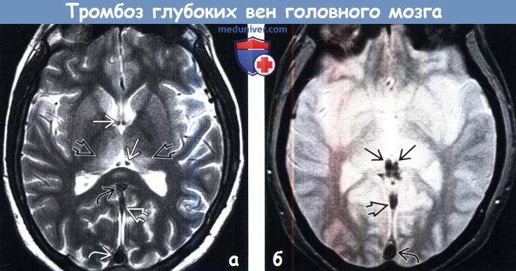 Тромбоз глубоких вен головного мозга на МРТ