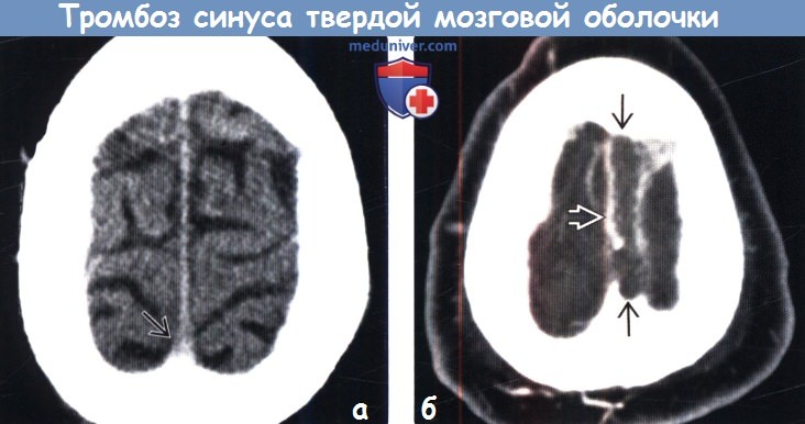 Тромбоз синуса твердой мозговой оболочки на КТ, ангиограмме