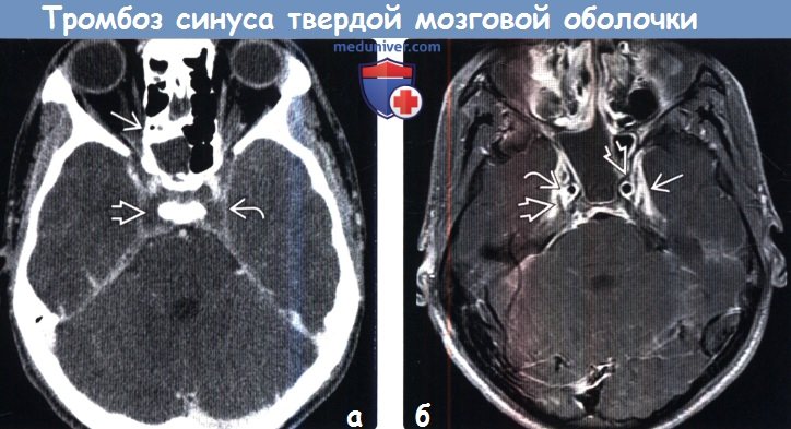 Тромбоз синуса твердой мозговой оболочки на КТ, МРТ, ангиограмме