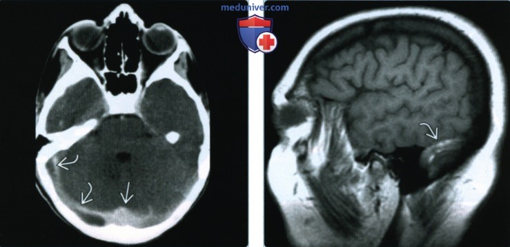 Тромбоз синуса твердой мозговой оболочки в области основания черепа - лучевая диагностика