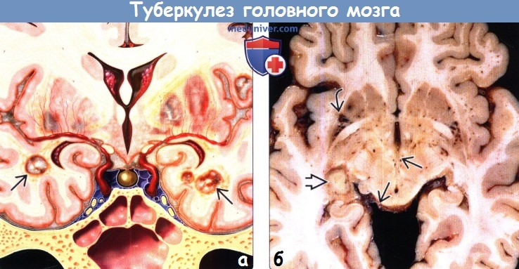 Туберкулез головного мозга