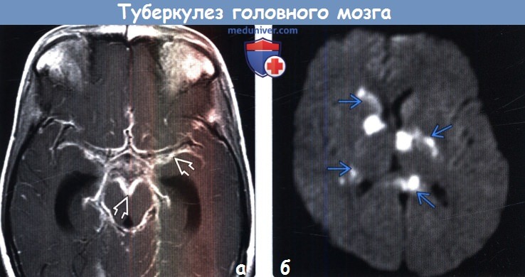 Туберкулез головного мозга на МРТ