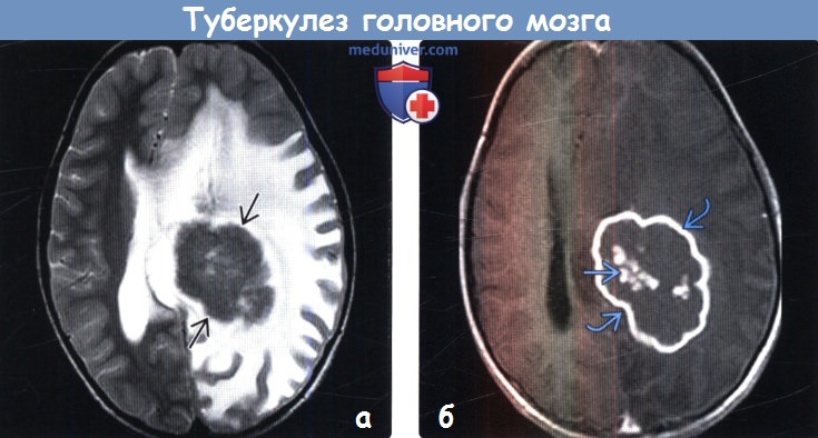 Туберкулез головного мозга на МРТ