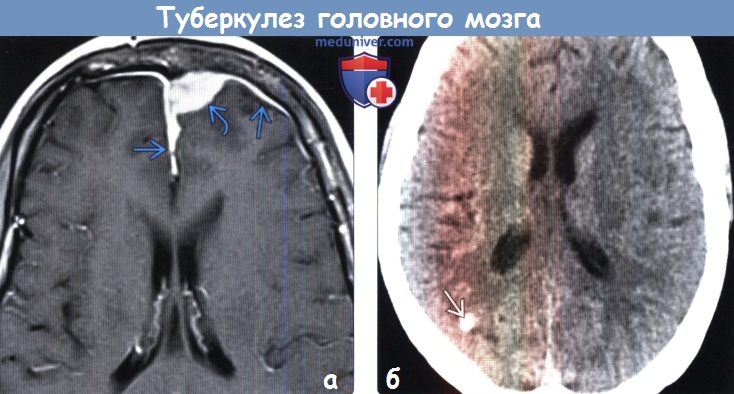 Туберкулез головного мозга на МРТ, КТ