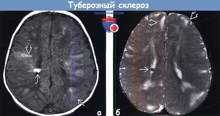 Туберозный склероз на МРТ