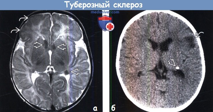 Туберозный склероз на МРТ